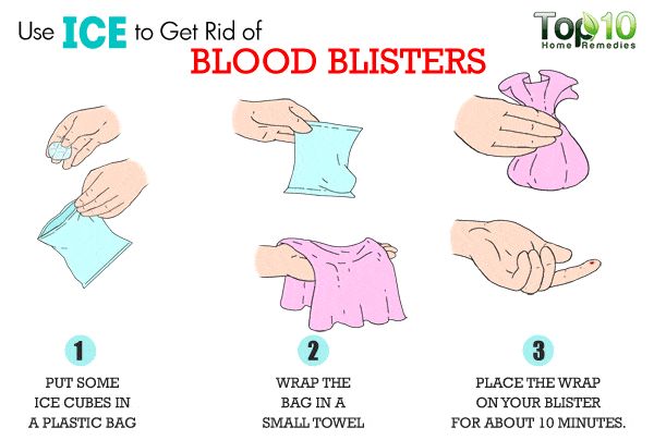 blood blister diagram wiring diagram data oreo How Does a Blister Form how to get rid of blood blisters who knew pinterest blood water blisters diagram blood blister diagram