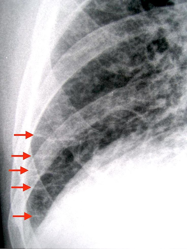 pulmonary edema lungs Pulmonary edema is fluid accumulation in the air spaces and parenchyma of the lungs it leads to impaired gas exchange and may cause respiratory failure. pulmonary edema lungs Pulmonary edema is fluid accumulation in the air spaces and parenchyma of the lungs it leads to impaired gas exchange and may cause respiratory failure.