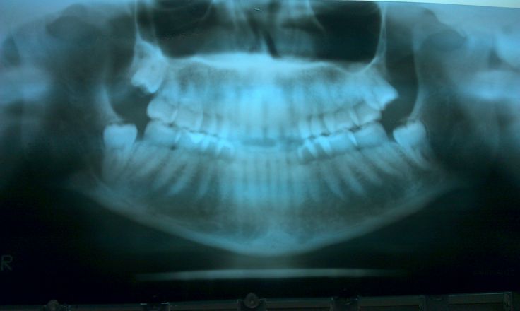 wisdom teeth xray