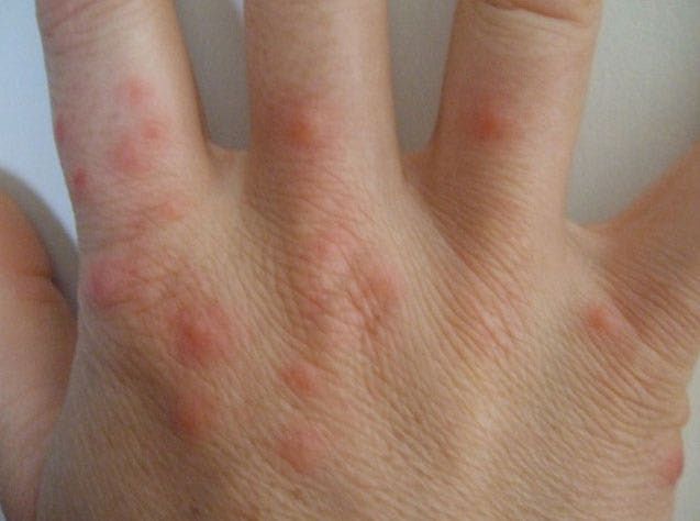 Pin On Bedbugs