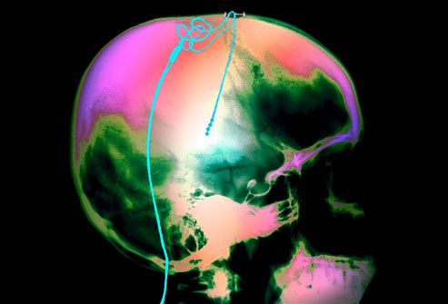 deep brain stimulation and parkinsons Los angeles -- a new type of deep brain stimulation system, with in patients with advanced, levodopa-responsive parkinson's disease in a. deep brain stimulation and parkinsons Los angeles -- a new type of deep brain stimulation system, with in patients with advanced, levodopa-responsive parkinson's disease in a.
