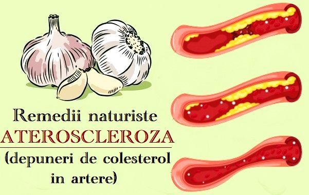 varicoza ateroscleroza