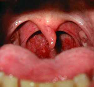 Home Remedies For Vocal Cord Problems Home Remedies For Vocal Cord Problems