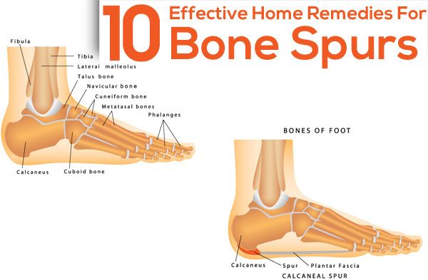 Natural Remedy For Bone Spurs In Neck Natural Remedy For Bone Spurs In Neck
