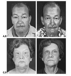 Vitiligo And Synthroid