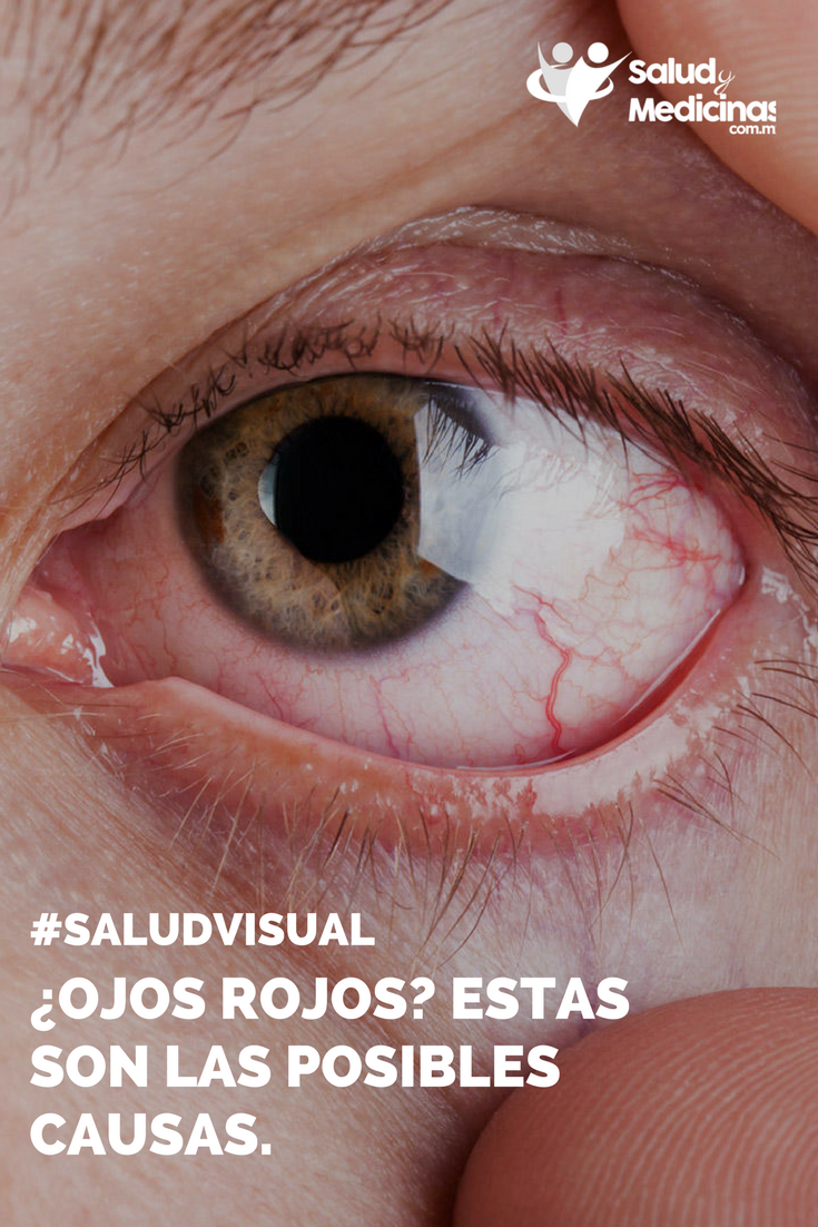 ¿Puede el VPH causar infecciones oculares?