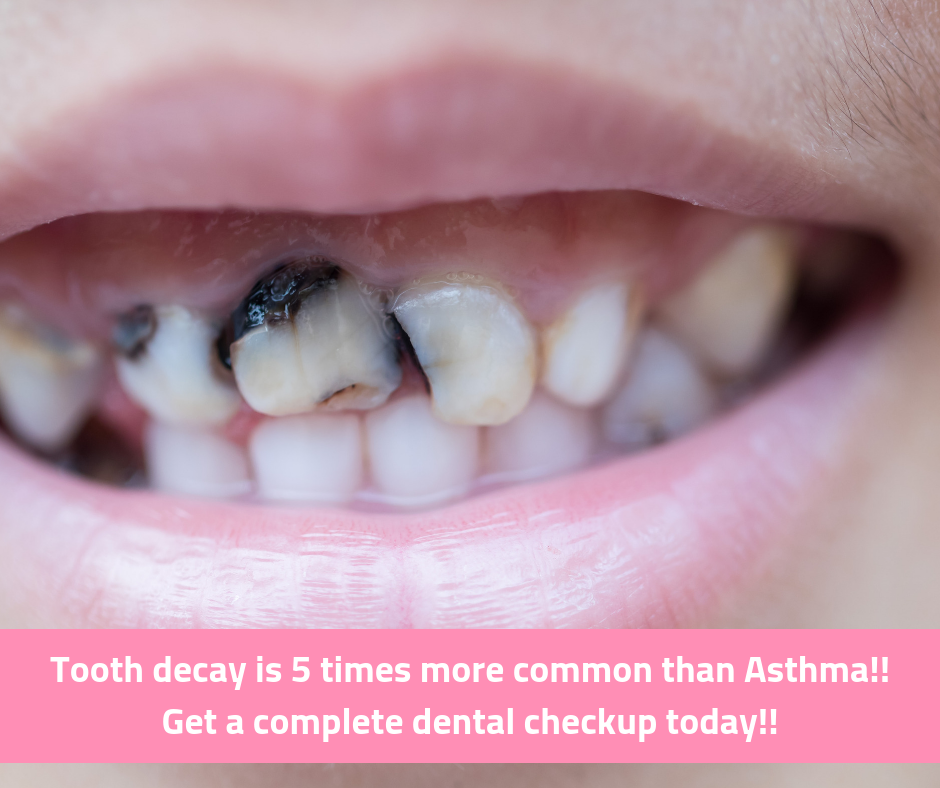 decay a Tooth than times Get ... common more Asthma!! 5 is Get Asthma!! common is than a more decay 5 ... Tooth times