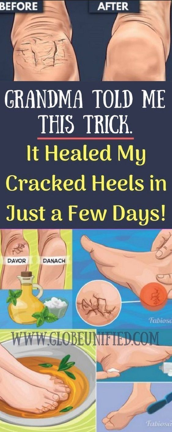 Cracked heels are a common foot problem. One survey found that 20 percent of adults in the United States experience cracked skin on their feet. This can occur in both adults and children, and seems to affect women more often than men. #crackedheels #cracked #heels #feet #foot #FoundationForDrySkin #SkinBleachingHomeRemedies #OilySkin #crackedskinonheels Cracked heels are a common foot problem. One survey found that 20 percent of adults in the United State #SkinWhiteningFace #crackedskinonheels