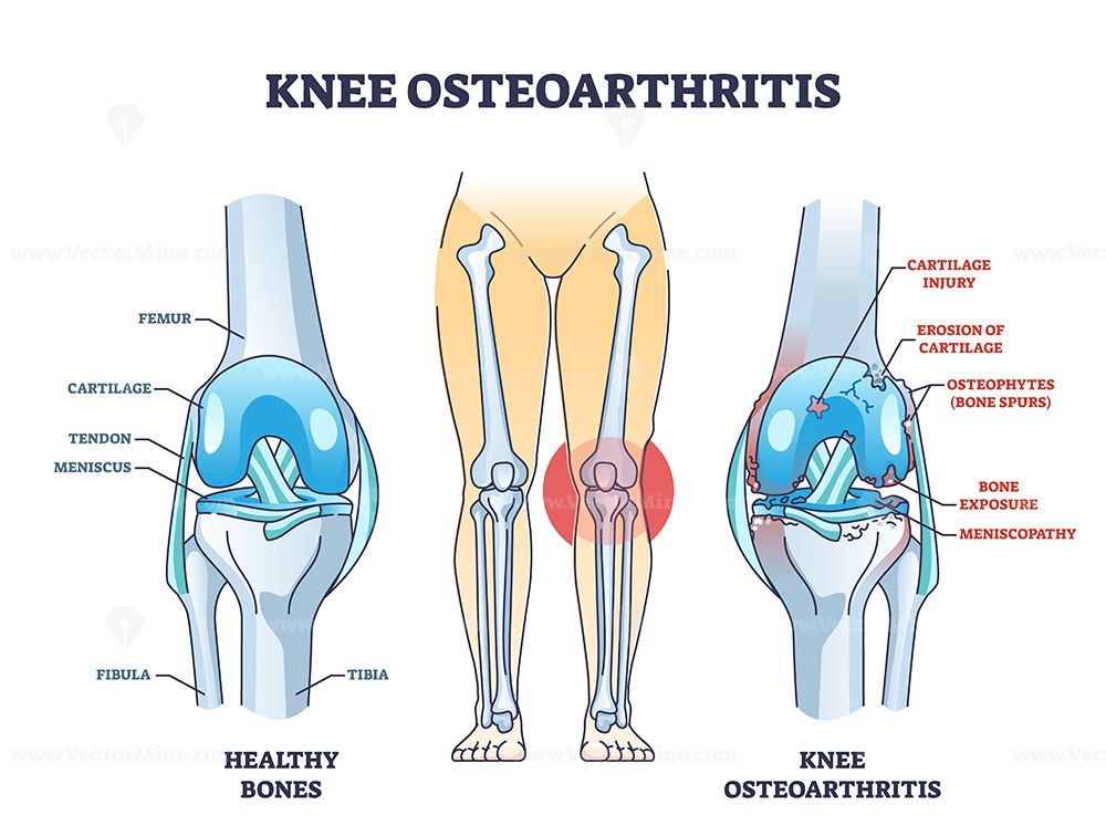Knee osteoarthritis condition with skeletal bone degeneration outline diagram. Labeled educational scheme with medical orthopedic disease vector illustration. Injury comparison with healthy leg bones. #knee #osteoartgritis #anatomy #care #cartilage #commercial #vector #illustration → Get this Illustration for Commercial Use! Knee Bones, Healthy Legs, Knee Osteoarthritis, Free Opening, Skeletal, Orthopedics, Cartilage, Plant Life, Comparison