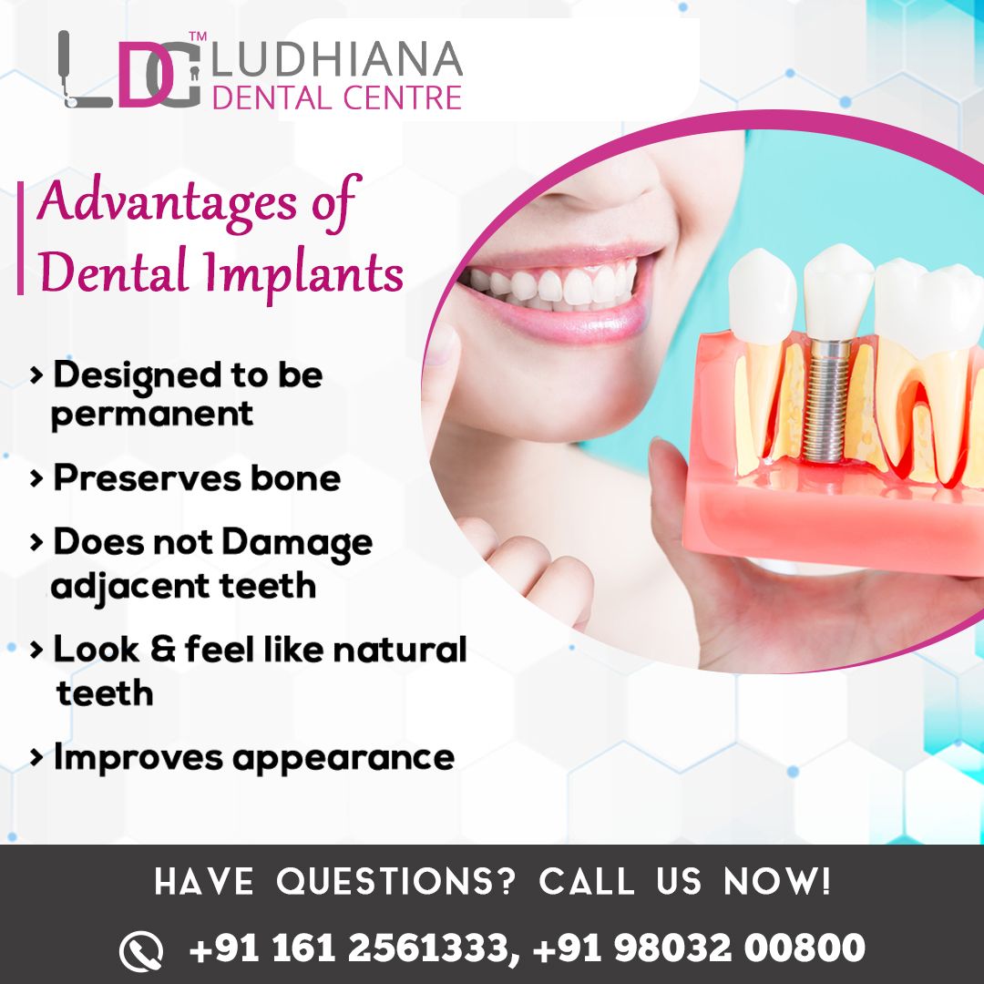 Advantages of Dental Implants in 2021 Dental implants, Dental clinic