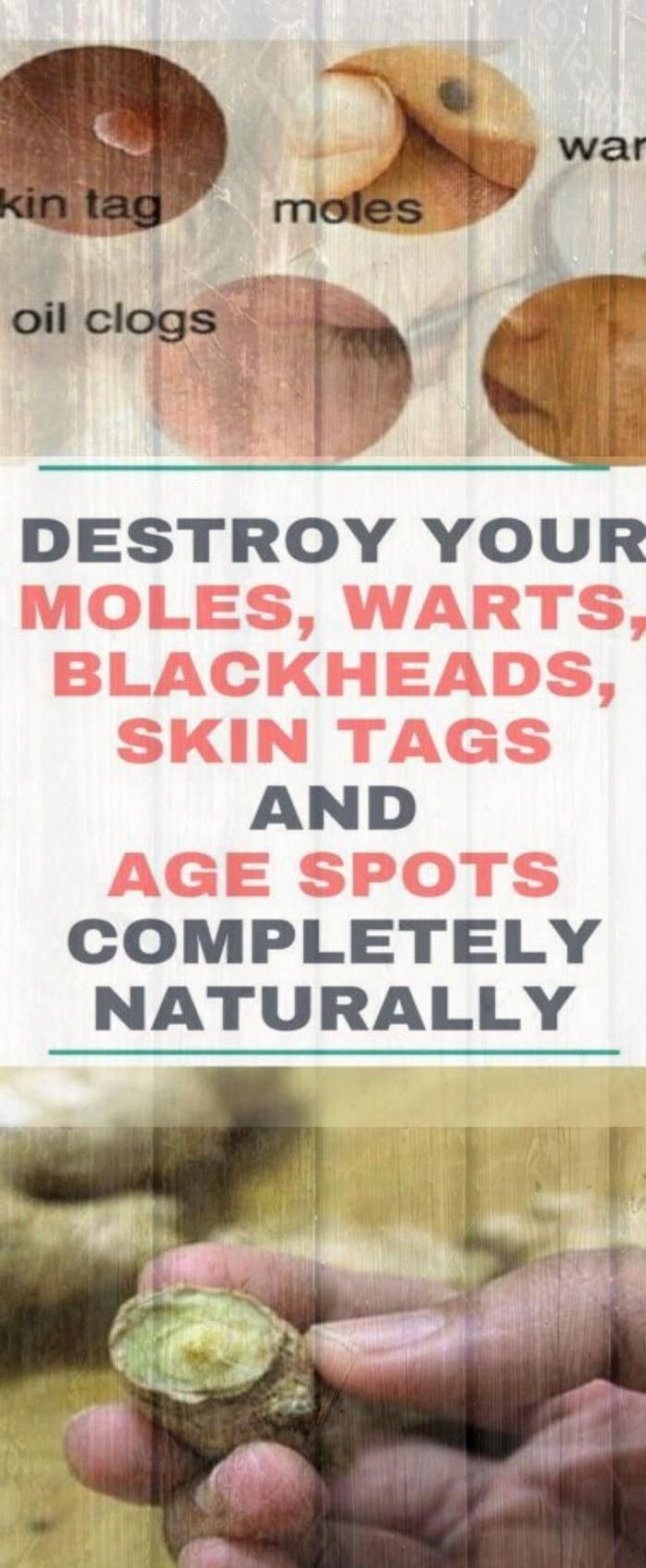 Destroy Your Moles #warts Blackheads Skin Tags And Age Spots Completely Naturally People experience...