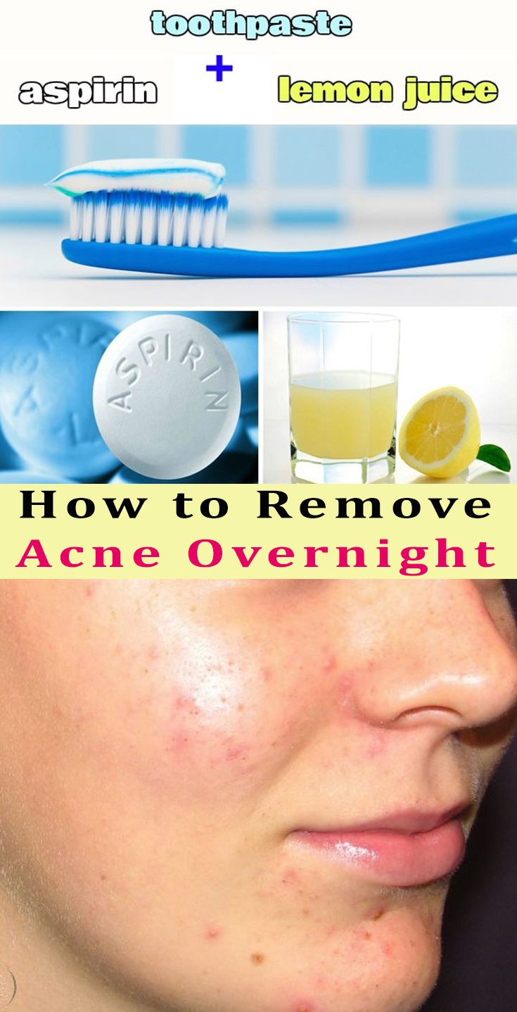 How to Remove Acne Overnight beauty health diy Acne