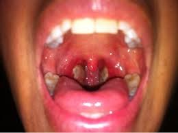 The major cause behind the occurrence of tonsillitis is bacterial infection. In this ailment the tonsils present in human body gets inflated. Tonsils are present in the lymphatic system of the body at the back part of throat. The major function of these two tissue balls is to prevent the disease and infection. Throat Pain, Strep Throat, Soft Chapati Recipe, Tonsilitis Remedy, Swollen Tonsils, Tonsils And Adenoids, Rheumatic Fever, Tissue Balls, Signs Of Inflammation