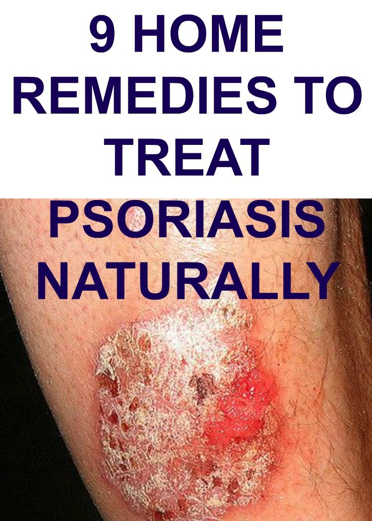 9 Home Remedies To Treat Psoriasis Naturally Treat Psoriasis