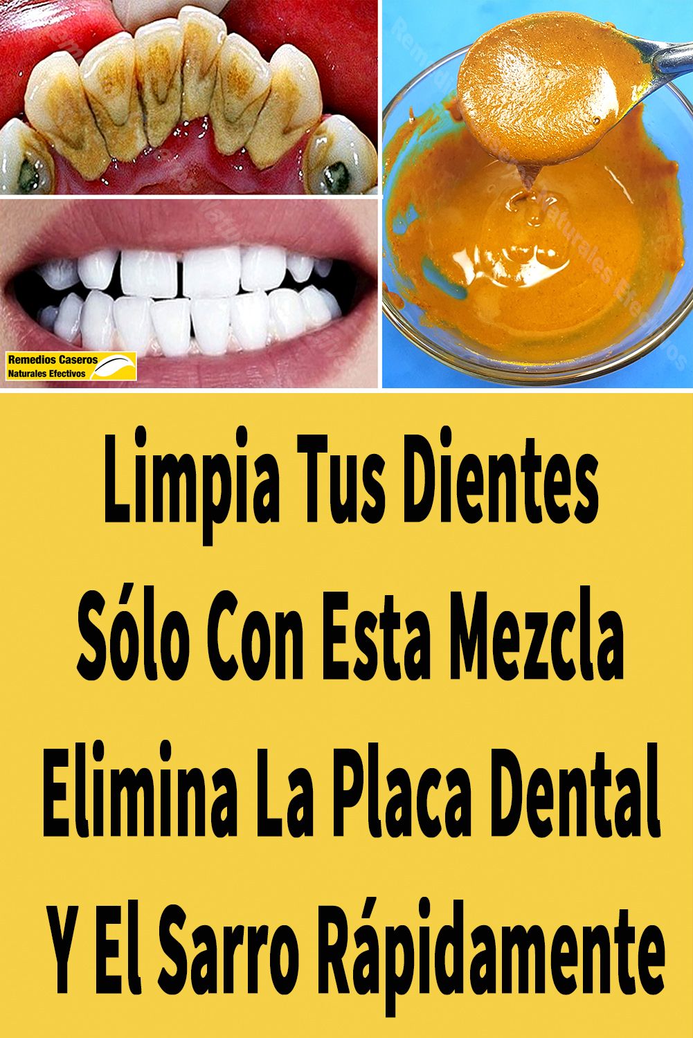 Limpia Tus Dientes Sólo Con Esta Mezcla Elimina La Placa Dental Y El Sarro Rápidamente Eliminar Sarro Dientes Remedios Para Adelgazar Remedios Para La Salud