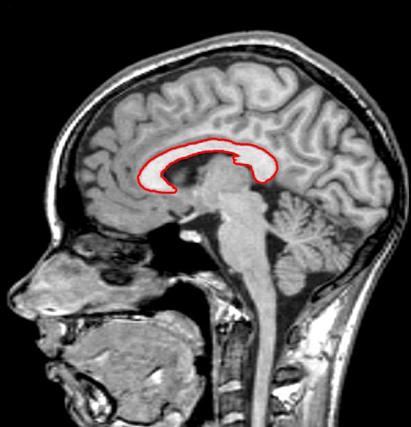 agenesia corpus callosum tx