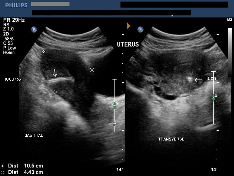 test iud positive pregnancy with ultrasound This image shows uterine Intra (or IUCD an test iud positive pregnancy with ultrasound This image shows uterine Intra (or IUCD an