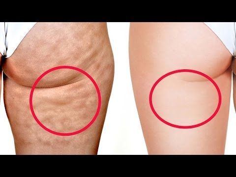 Masaj anticelulitic panosundaki Pin