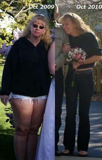 Weight loss surgery and kidney transplant picture 6