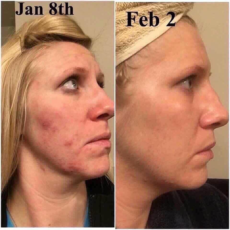 Is Accutane Covered By Health Insurance