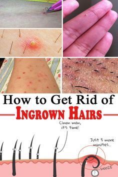 Incredible How To Get An Ingrown Hair Out Of Your Armpit References