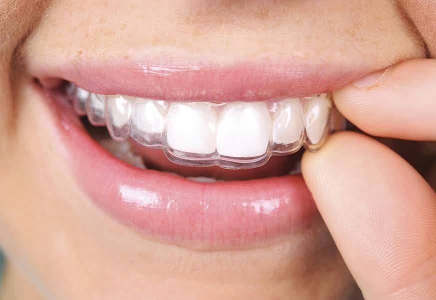 Invisible Aligner AtHome Impression Kit