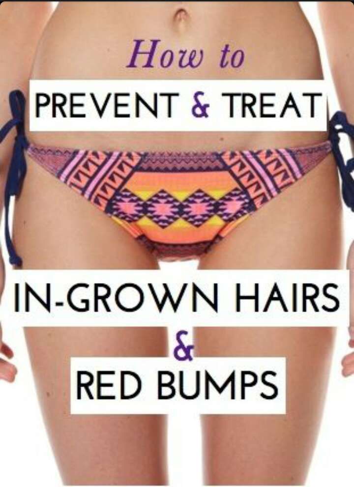 Best of Bikini wax ingrown hair hair Bikini wax ingrown