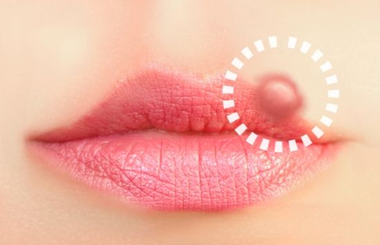 herpes dating blogi