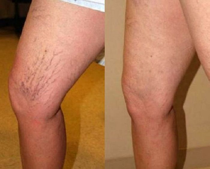 cum de a preveni mainile varicoase pe picioare