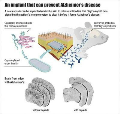 Pin On Alzheimer S