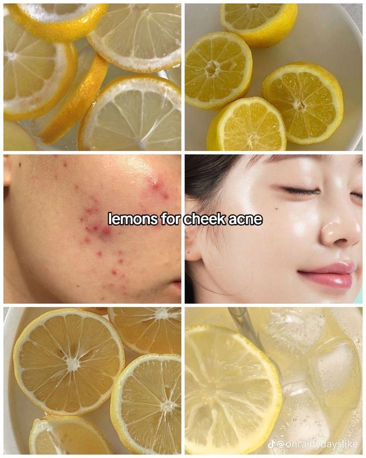 fruits for acne!
