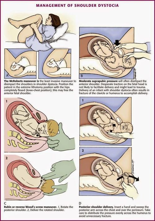 shoulder dystocia 1 midwifery ob nursing shoulder shoulder dystocia