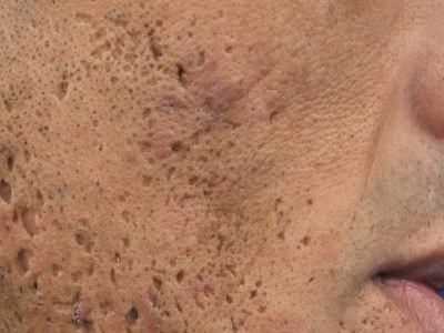 dating a man with acne