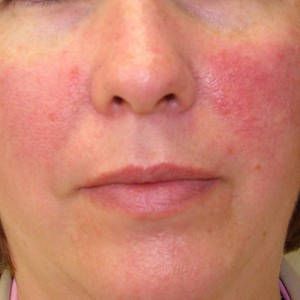 Best 5 Cosmetics For Rosecea How To Cure Rosecea With Cosmetics Rosacea Tratamiento Rosácea Remedios Para La Rosácea