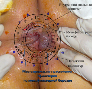 kak-otkrit-analniy-prohod