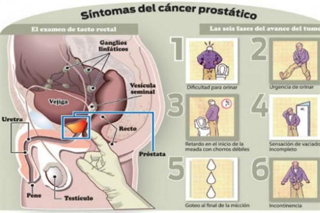examen para cancer de prostata