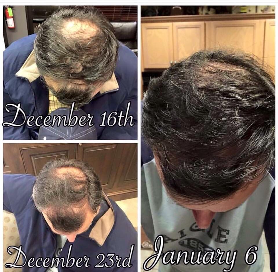 Say Goodbye To Male Pattern Baldness Www Sloanmcnulty Mymonat Com