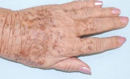 What Causes Old Age Spots Aimee S Skin Care Solutions Brown Age Spots Old Age Spots Age Spots
