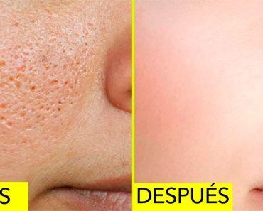 10 Remedios Caseros Para Reducir Los Poros Abiertos En Su Piel Skin Clogged Pores Flaking Skin