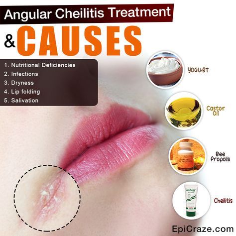 Cracked corners of mouth image by P incurs approaching lips