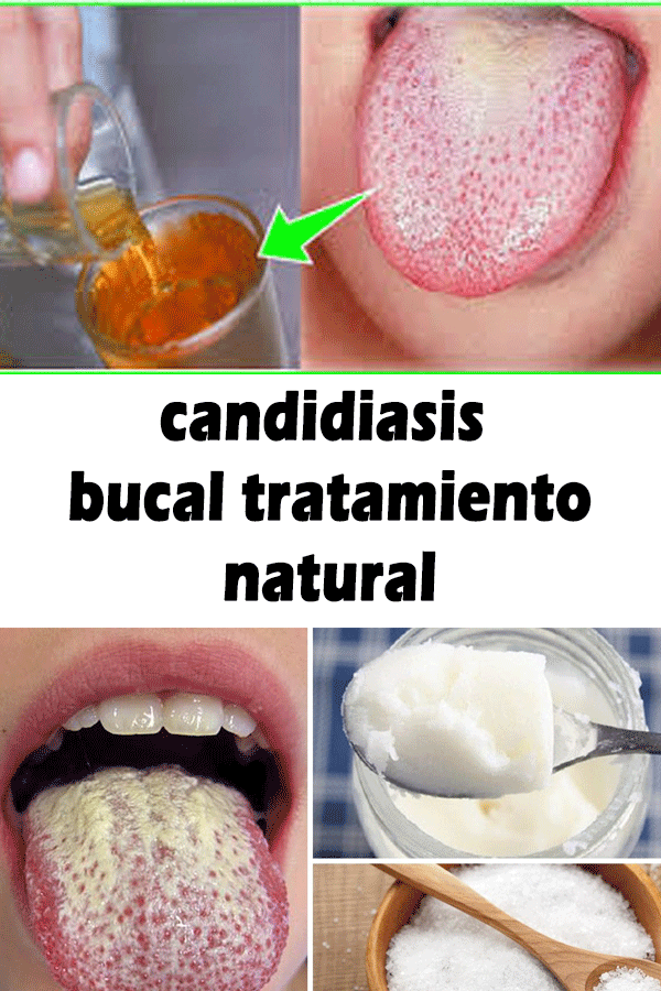 Tratamiento candidiasis oral fluconazol Tratamiento candidiasis oral fluconazol