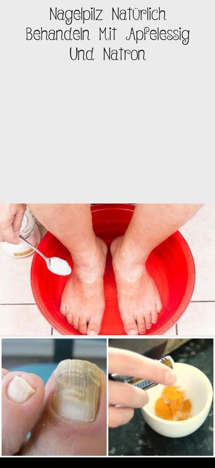 Treat Nail Fungus Naturally With Apple Cider Vinegar And Baking Soda Nail Design Apple Baking Cider Fungus Naturally In 2020 Nagelpilz Backpulver Nagel Natron