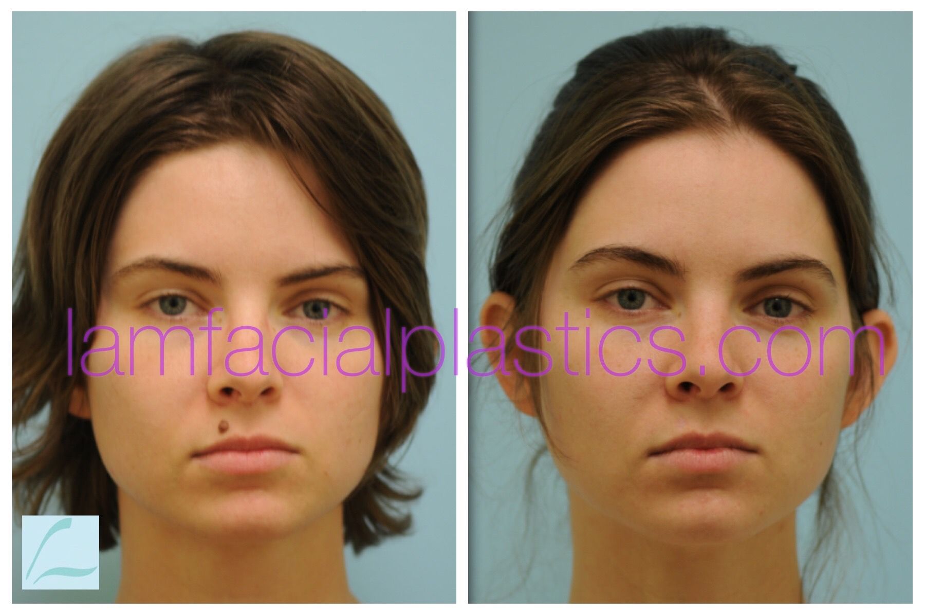 This young lady had a mole removed from her upper lip and is shown