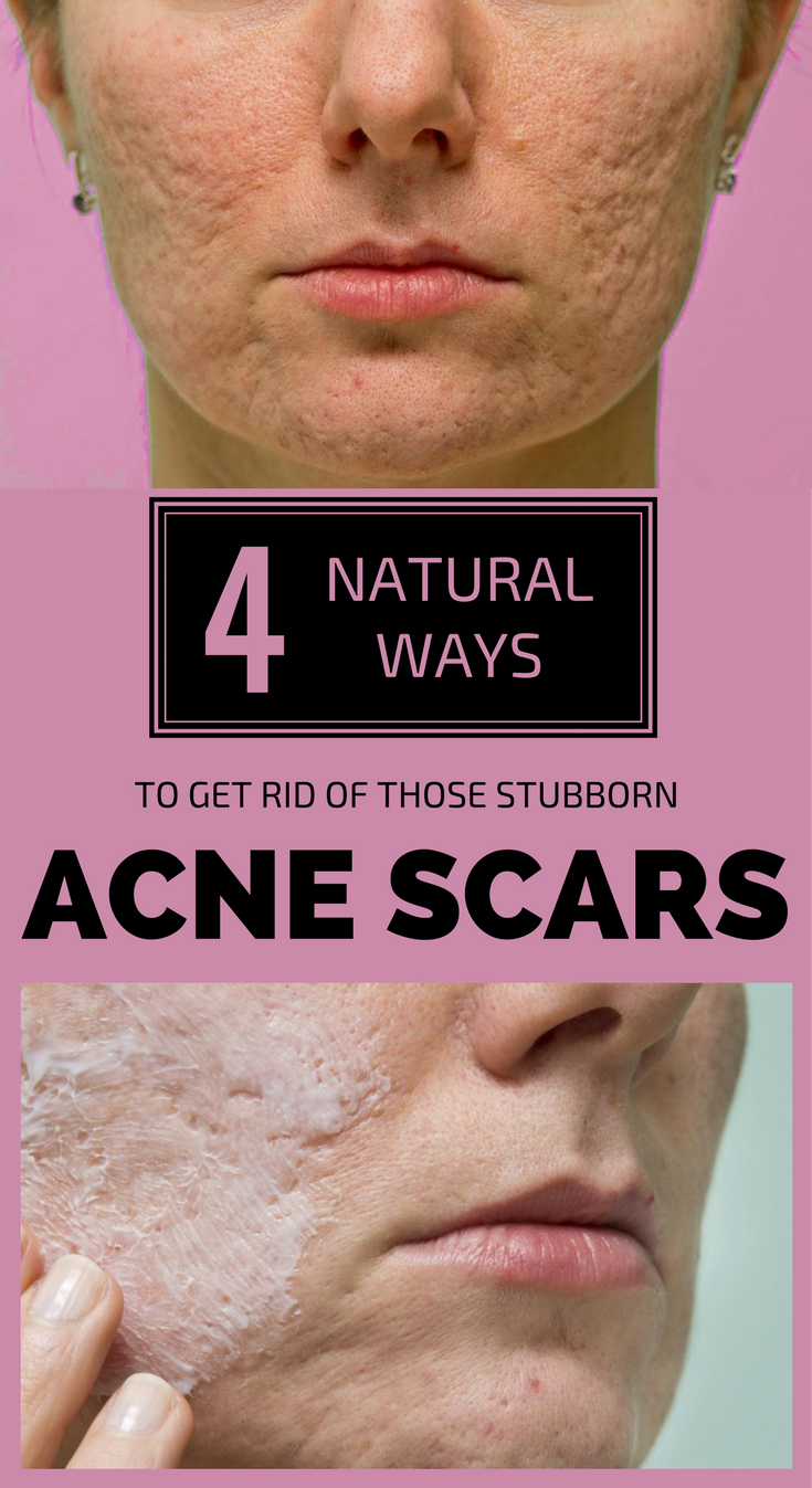 How To Get Rid Of Those Stubborn Bumps On The Back Of Your Arms And Legs forecasting How To Get Rid Of Those Stubborn Bumps On The Back Of Your Arms And Legs recommendations