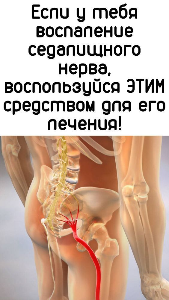 Пин на доске Седалищный нерв