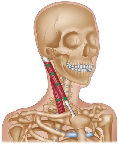 Sternocleidomastoid (SCM) Syndrome
