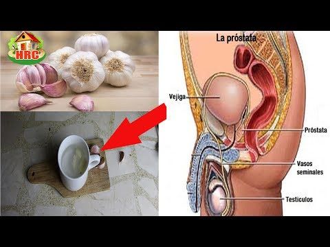 piedras en la próstata y la vejiga remix youtube