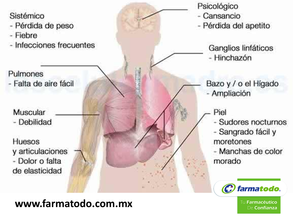 Sin síntomas leucemia Sin síntomas leucemia