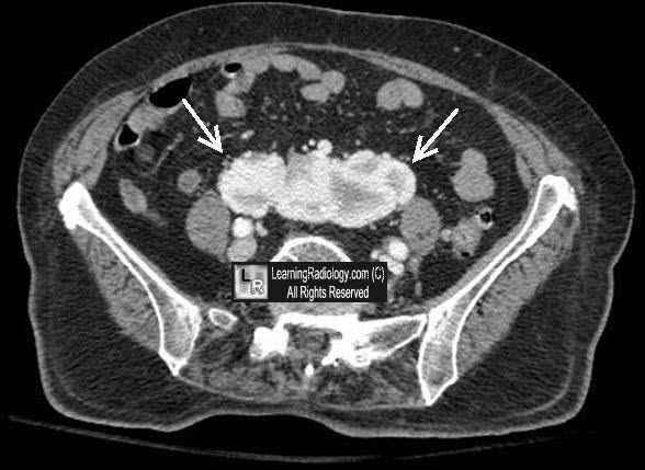 pancake kidney fusion of both poles of kidney signs in radiology pancake kidney fusion of both poles of kidney