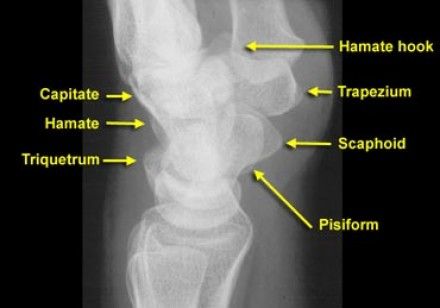 Carpels lateral labeled | Radiology, Radiologic technology, Emergency